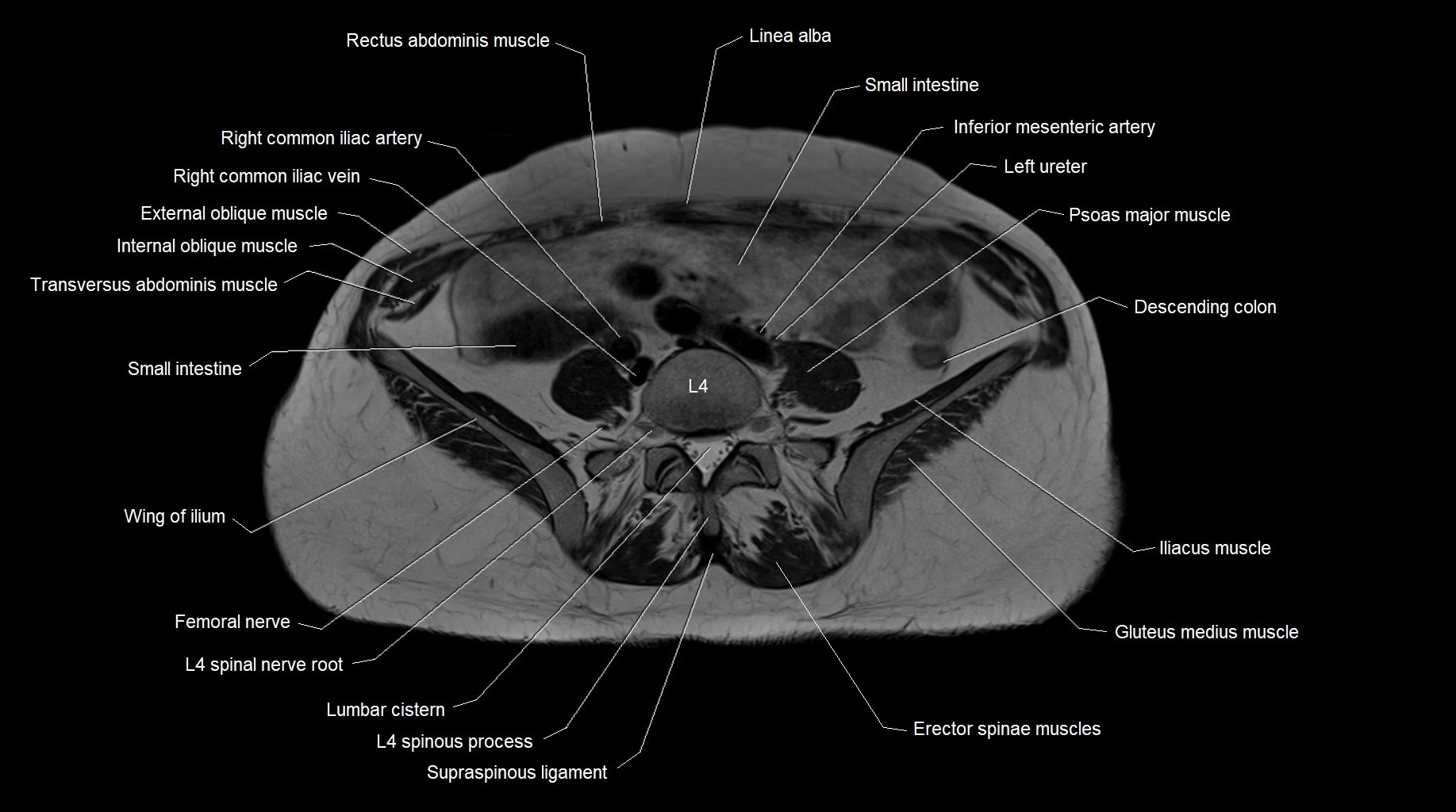 MRI 3T pelvis axial cross section anatomy image 3.webp